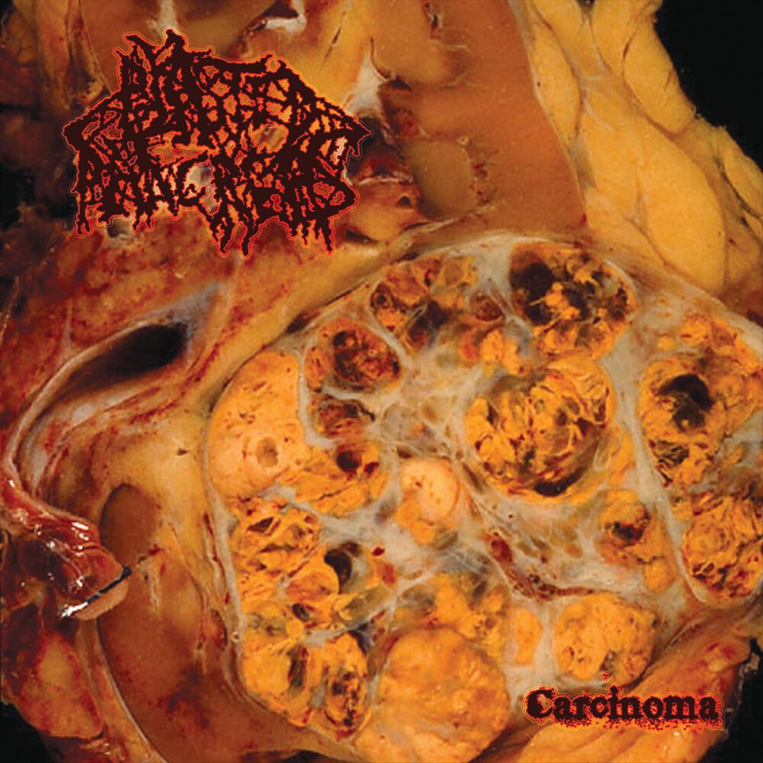 Carcinoma cover art